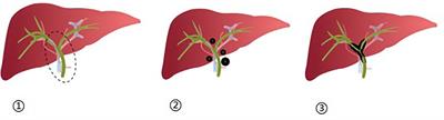 Initial investigation on ultrasound-guided percutaneous biopsy of lesions in the first hepatic hilum with fusion of ultrasound and multimodal imaging cognitive guidance